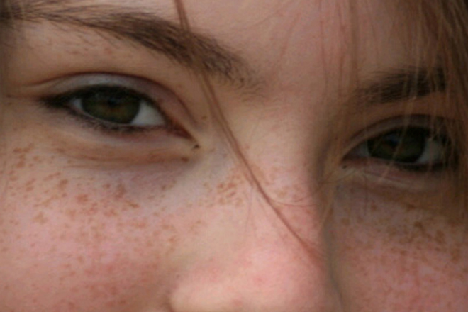 Tàn nhang thường xuất hiện trên mặt