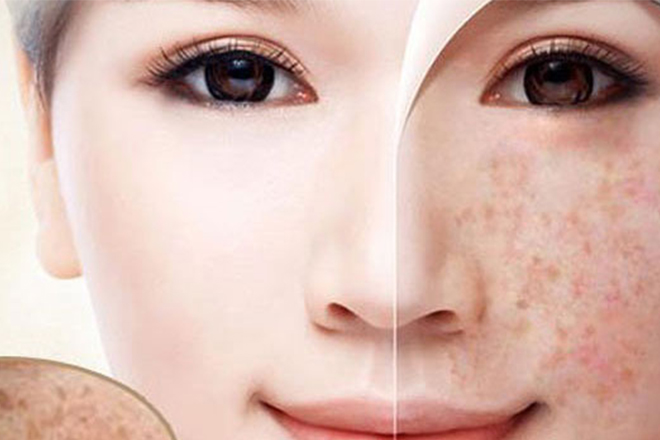 Kem trị tàn nhang Sắc Ngọc Khang có thực sự hiệu quả? Điều trị tàn nhang